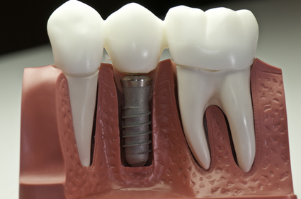 This model show the teeth have been capped and the stainless pin in the gums.