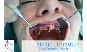 Cosa sono gli impianti dentali Studio Dentistico Dott. Ermanno Celestino Rende