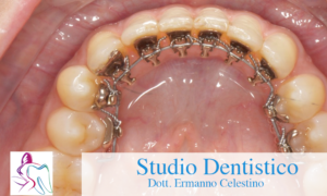ORTODONZIA LINGUALE Studio Dentistico Dott. Ermanno Celestino Rende